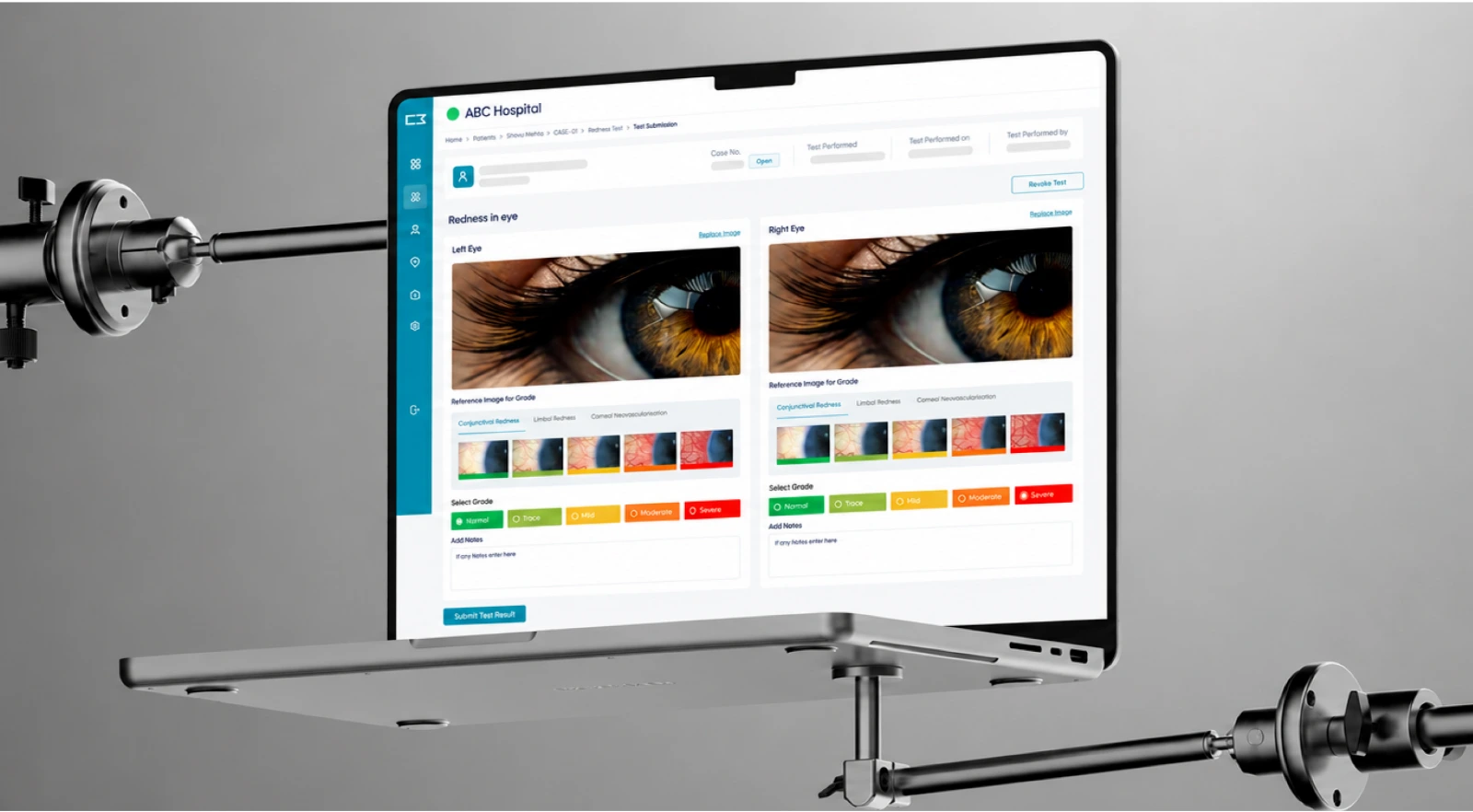 The C3 MedTech clinic dashboard on a laptop mounted to a slit lamp, showing left and right eye images with redness grading.