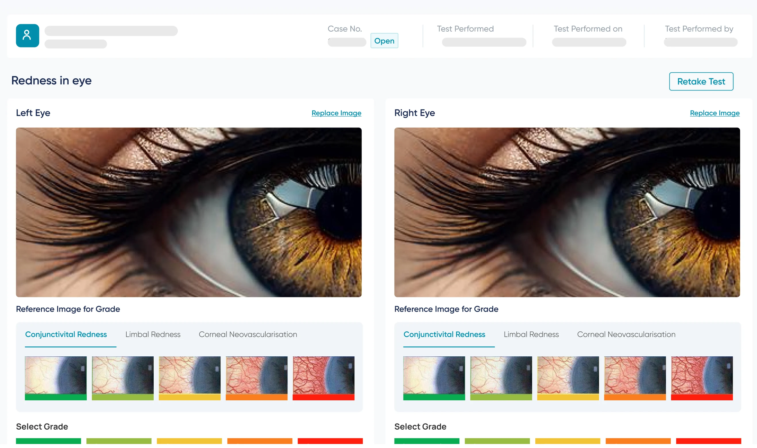 The redness-in-eye test — left and right eye photographs side by side with reference images and colour-graded scales for conjunctival redness scoring.