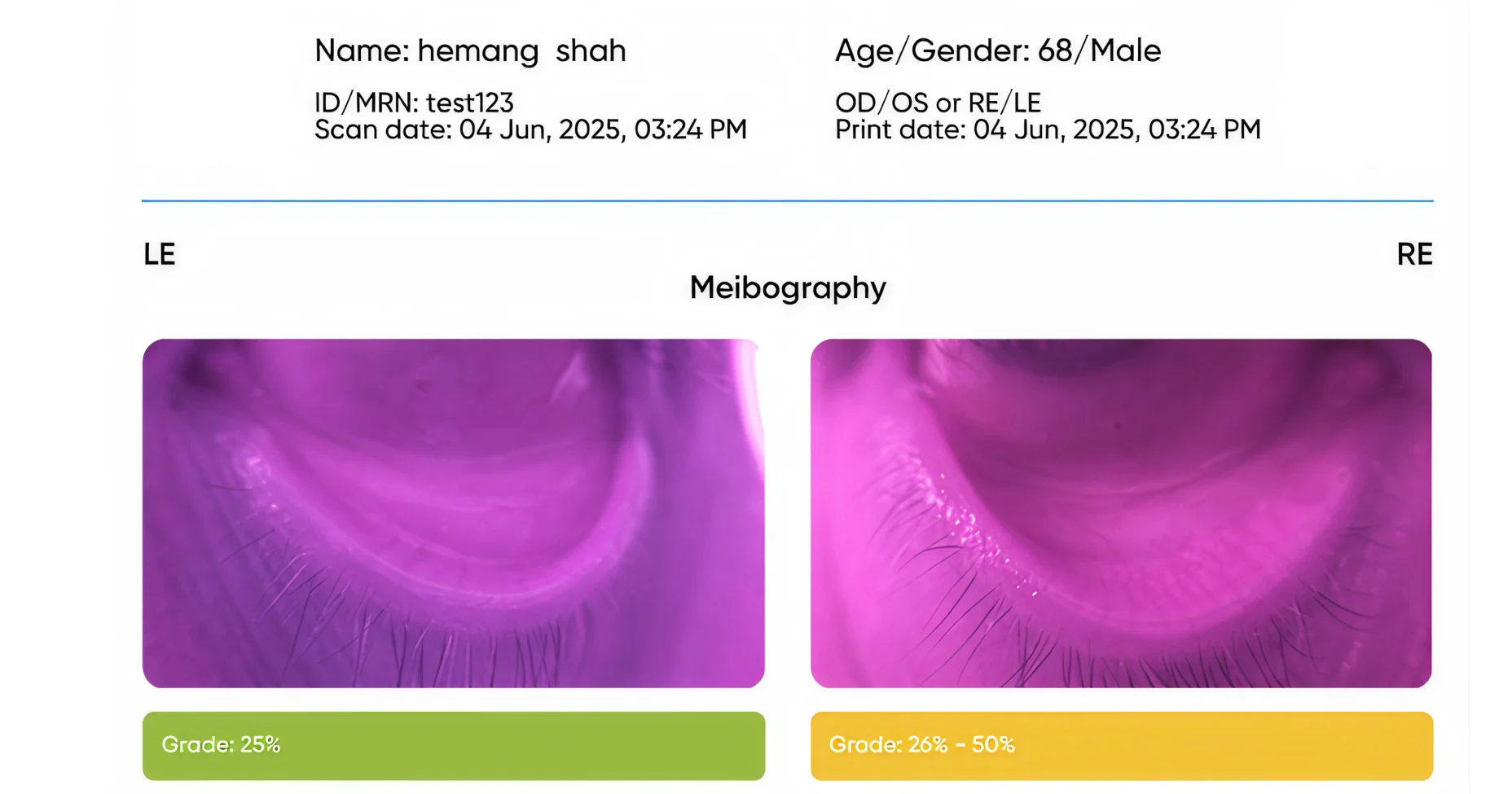 An auto-generated patient report — name, age, scan and print dates over left- and right-eye meibography imagery.